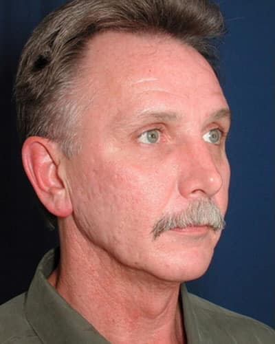 Before Image: Facelift - right-front-oblique
