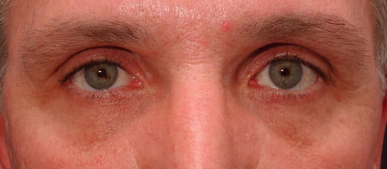 Before Image: Facelift - front