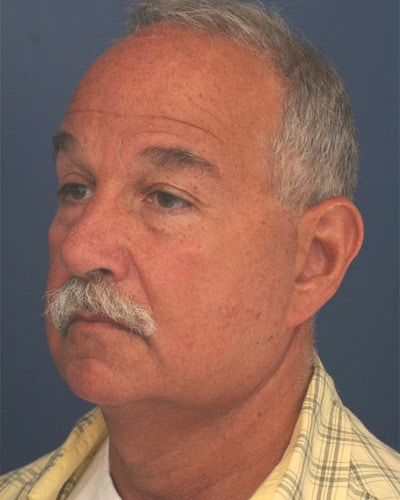 After Image: Facelift - left-front-oblique