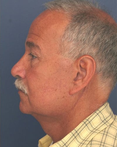 After Image: Facelift - left-side