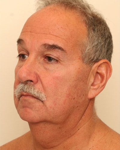 Before Image: Facelift - left-front-oblique