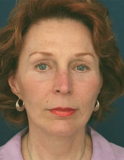 After Image: Facelift - front