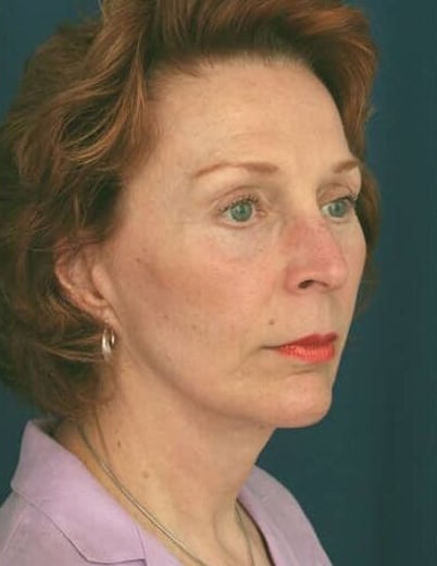 After Image: Facelift - right-front-oblique