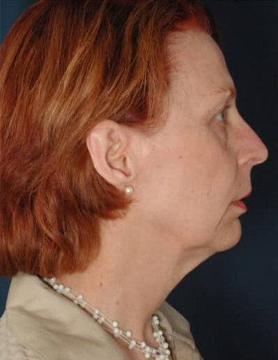 Before Image: Facelift - right-side