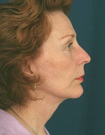 After Image: Facelift - right-side