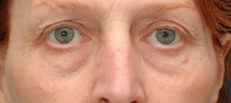 Before Image: Facelift - front