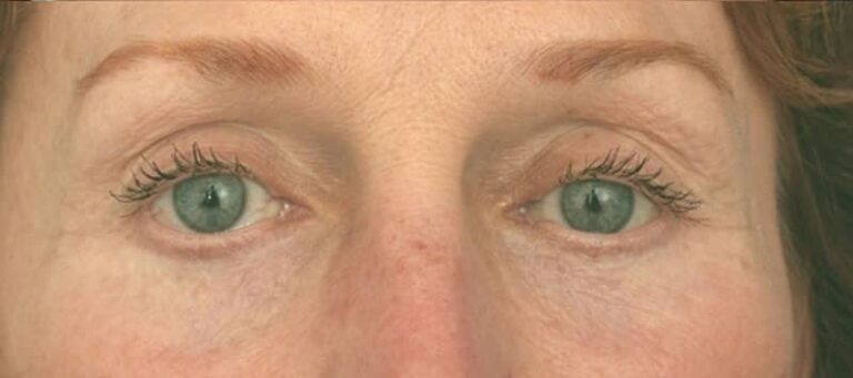 After Image: Facelift - front