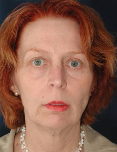 Before Image: Facelift - front