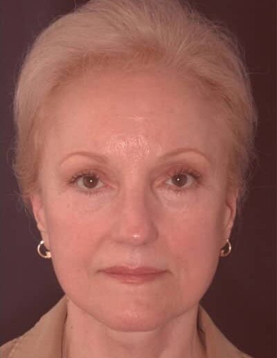After Image: Facelift - front