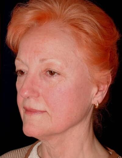 Before Image: Facelift - left-front-oblique
