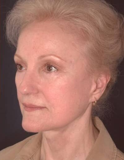 After Image: Facelift - left-front-oblique