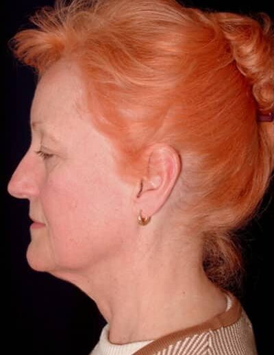 Before Image: Facelift - left-side