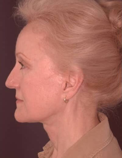 After Image: Facelift - left-side