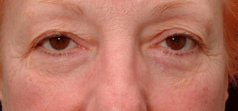 Before Image: Facelift - front