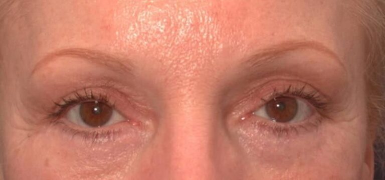 After Image: Facelift - front