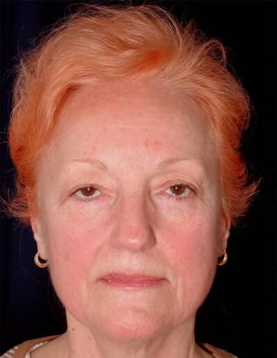 Before Image: Facelift - front