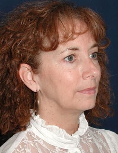 Before Image: Facelift - right-front-oblique