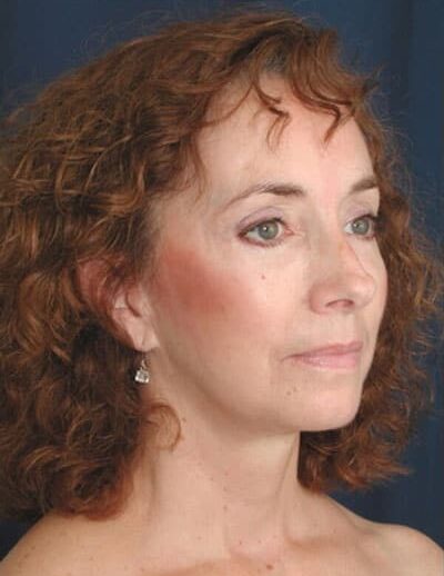 After Image: Facelift - right-front-oblique