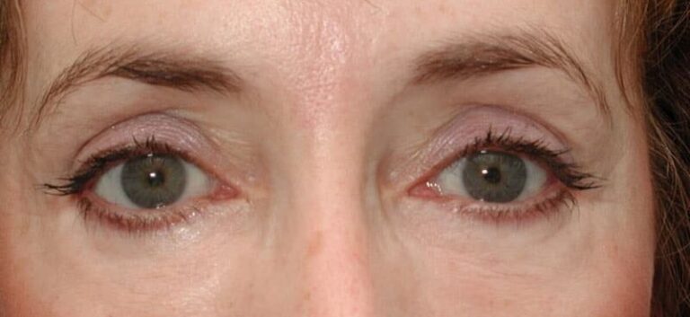 After Image: Facelift - front