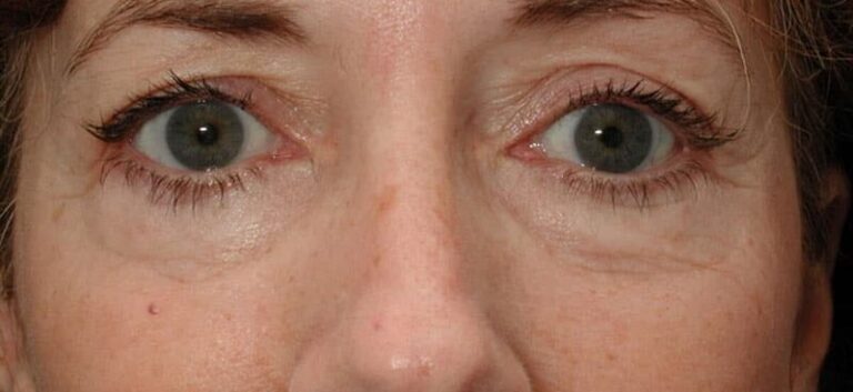 Before Image: Facelift - front