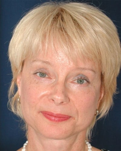 After Image: Facelift - front