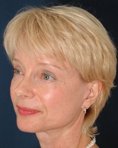 After Image: Facelift - left-front-oblique