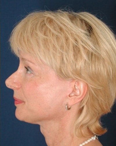 After Image: Facelift - left-side