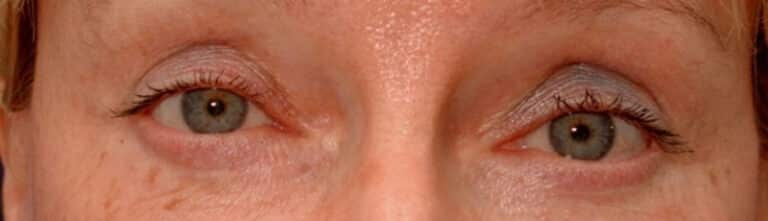 After Image: Facelift - front