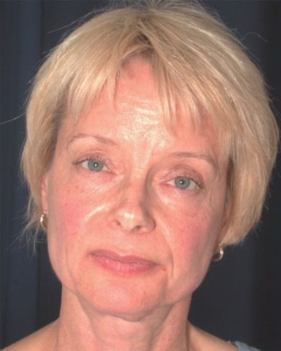Before Image: Facelift - front