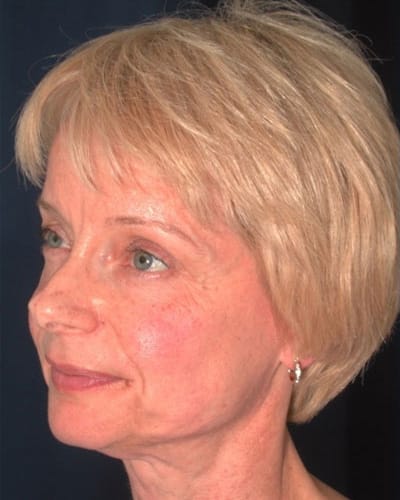 Before Image: Facelift - left-front-oblique