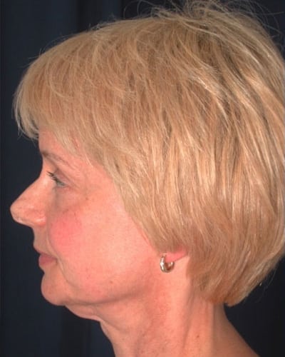 Before Image: Facelift - left-side