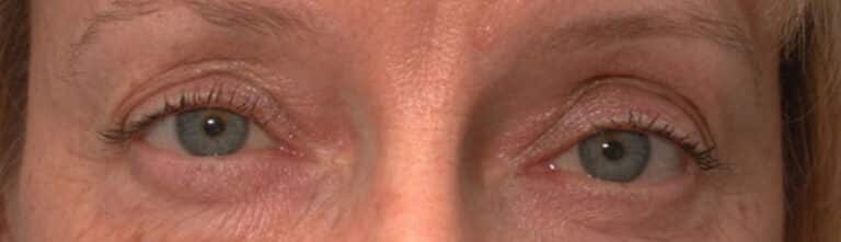Before Image: Facelift - front