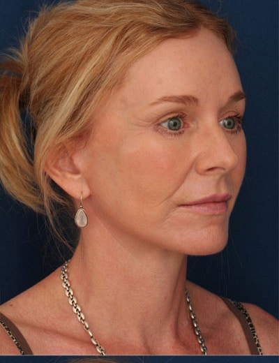 After Image: Facelift - right-front-oblique
