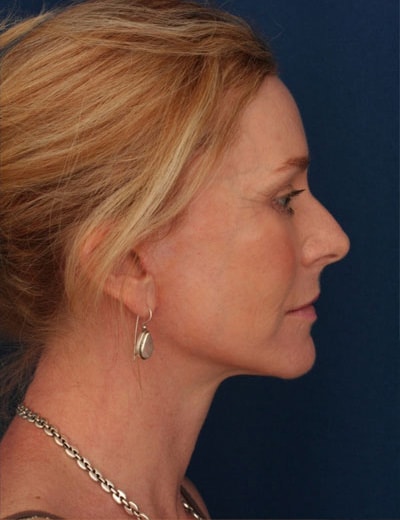 After Image: Facelift - right-side