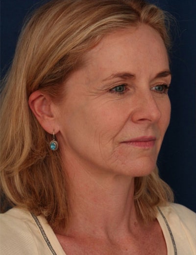 Before Image: Facelift - right-front-oblique