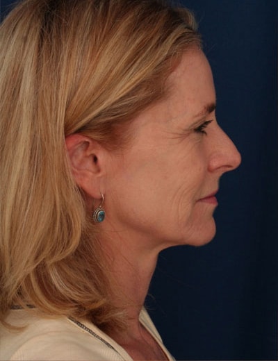 Before Image: Facelift - right-side