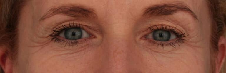 Before Image: Facelift - front