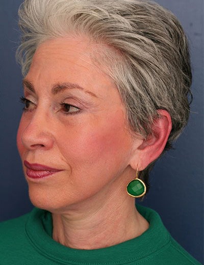 After Image: Facelift - left-front-oblique