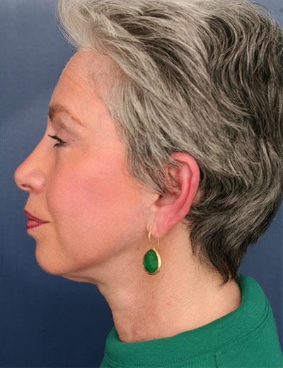 After Image: Facelift - left-side