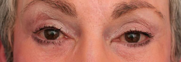 After Image: Facelift - front