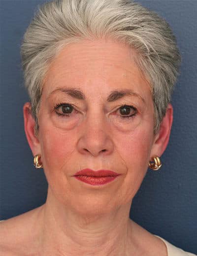 Before Image: Facelift - front