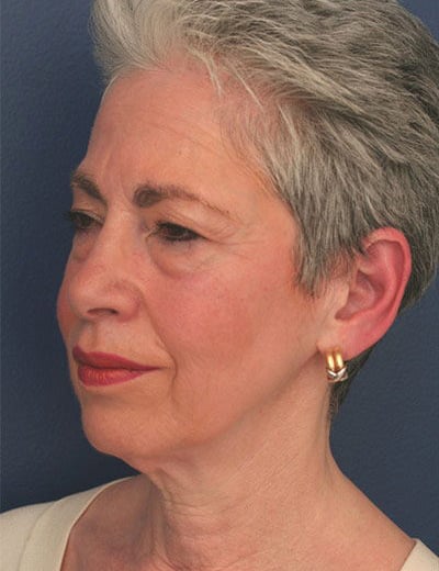 Before Image: Facelift - left-front-oblique