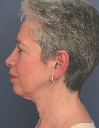 Before Image: Facelift - left-side