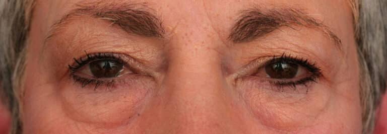 Before Image: Facelift - front