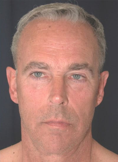 After Image: Facelift - front