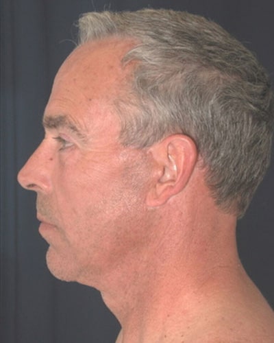 After Image: Facelift - left-side