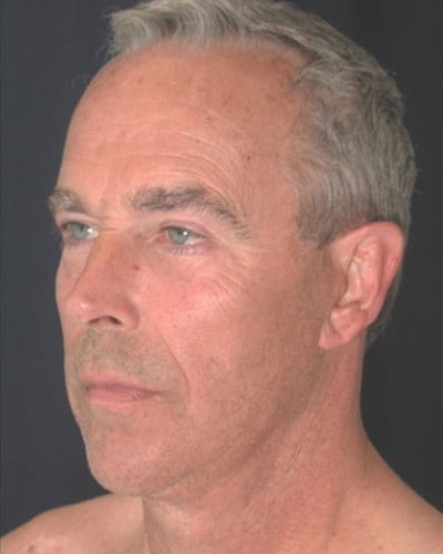 After Image: Facelift - left-front-oblique