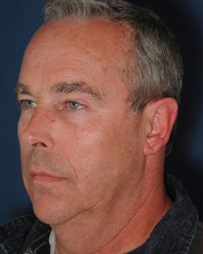 Before Image: Facelift - left-front-oblique