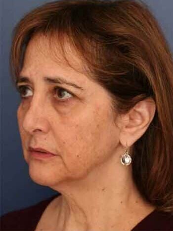 Before Image: Facelift - left-front-oblique