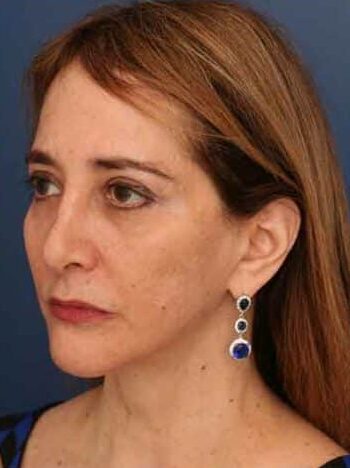 After Image: Facelift - left-front-oblique